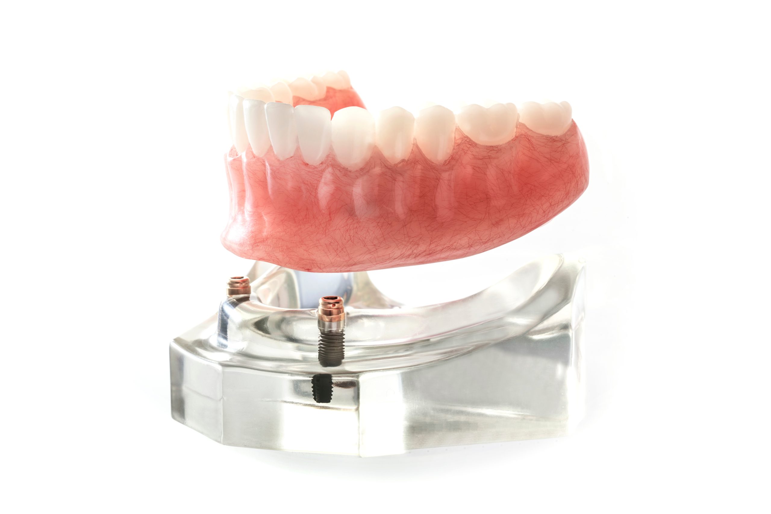 https://www.evalledenture.com/wp-content/uploads/2025/03/Denture-Over-Implant-scaled.jpeg