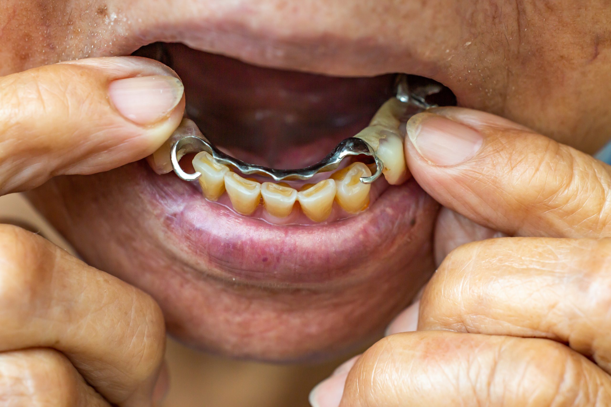 Artificial teeth gripped by the hand of senior's  woman, Acrylic and Vitallium metal, Stomatology & False Dentures set concept, Close up & Macro shot, Selective focus