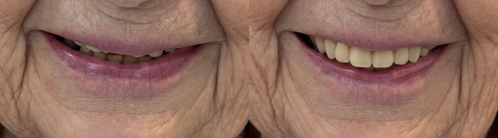 mouth_before_after_crop