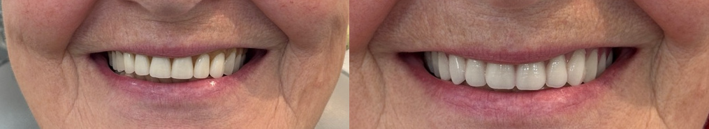 mouth_before_after_crop3