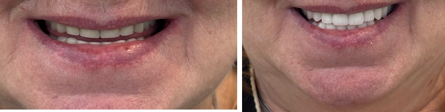 mouth_before_after_pair2